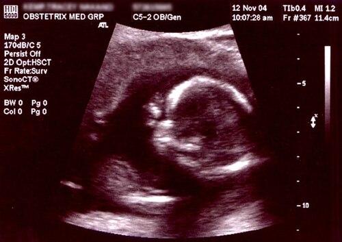 500px-Obsteric_ultrasonograph Archiwalny wydruk USG z 2004 r.: widoczna główka i sylwetka dziecka w łonie matki. Zdjęcie ilustracyjne, nie dokumentuje wydarzeń w Liechtensteinie.
